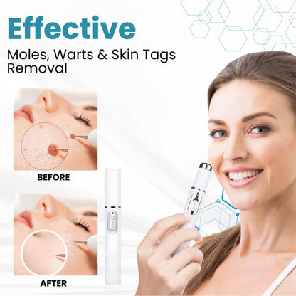 Natravor™ Non-Invasive Mole and Wart Removal Laser Pen